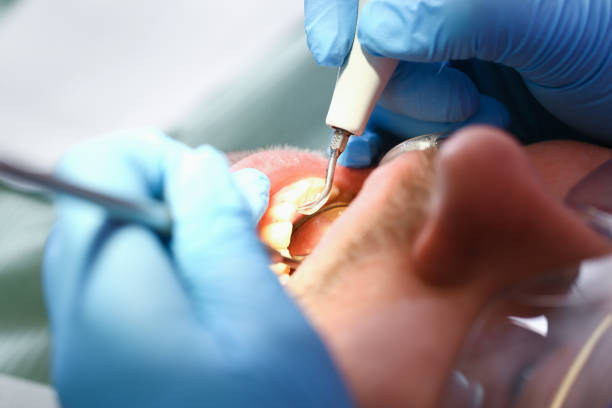 Best Emergency Dental Care for Broken or Chipped Teeth in San Angelo, TX