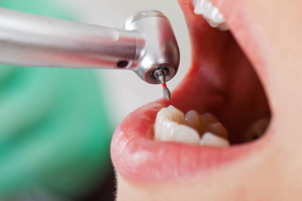 Best Urgent Care for Lost Fillings or Crowns in San Angelo, TX